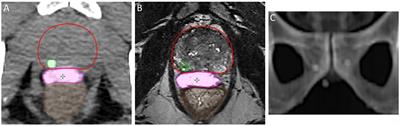 The role of a radiopaque peri-rectal hydrogel spacer in aiding accurate daily image-guidance for prostate stereotactic radiotherapy